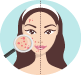 Acne Treatment